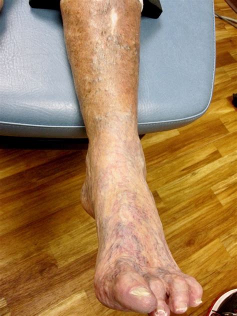 Peripheral Arterial Disease Pad Timonium Foot And Ankle Center