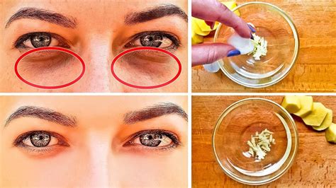 How To Get Rid Of Black Circles Under Your Eyes Youtube Eye Bags