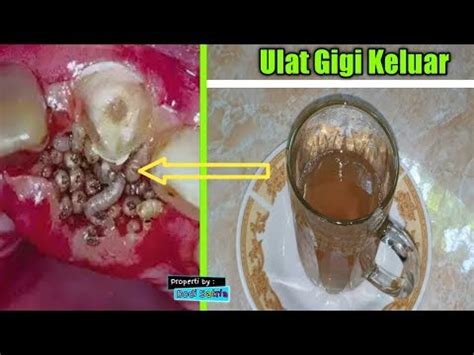 Cara Menyembuhkan Sakit Gigi Dalam 1 Hari - Bisabo Channel ...