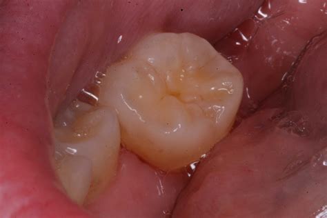 Mint Clinic Wisdom Tooth