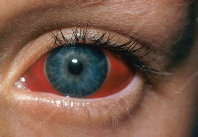 Can I Wear Contact Lenses With Subconjunctival Hemorrhage WeArEllison Com