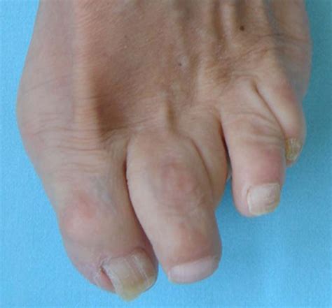 Toe Deformities The Foot And Ankle Online Journal