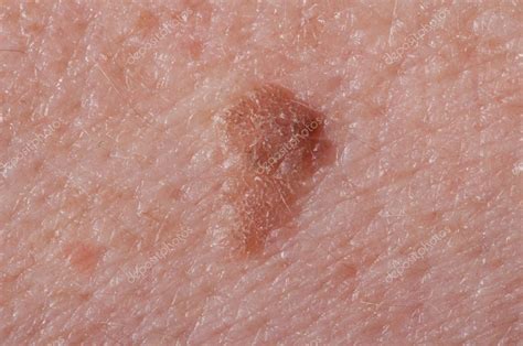 Liver Spots Stock Photo By ©roblan 14132514