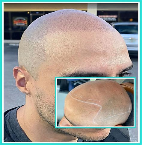 Worried about your thinning hair? Scalp micropigmentation to cover hair thinning with a soft ...