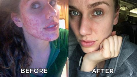 Beauty Bloggers Stunning Acne Transformation