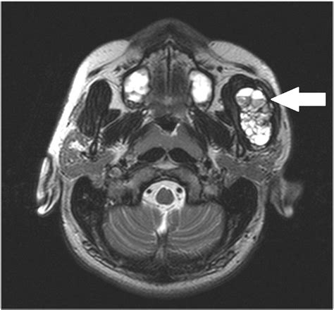 Aneurysmal Bone Cyst Of The Zygomatic Arch A Case Report Clinical