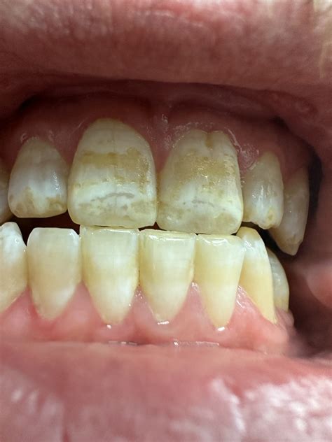 Small White Bump Above My Upper Tooth Have Two Similar But Smaller