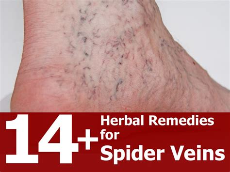 14 Herbal Remedies For Spider Veins