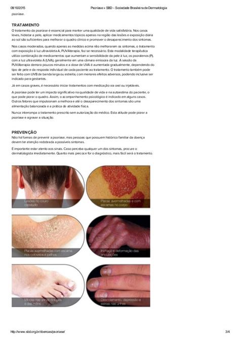 Psoríase Sbd Sociedade Brasileira De Dermatologia