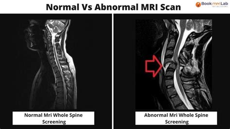 MRI Whole Spine Screening Purpose Results Cost