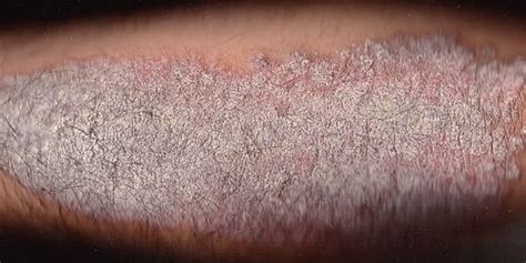 Severe Psoriasis Linked With Poorly Controlled Blood Pressure 2