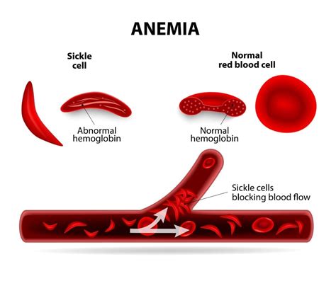 It is marked by flawed hemoglobin. Sickle Cell Disease - familydoctor.org