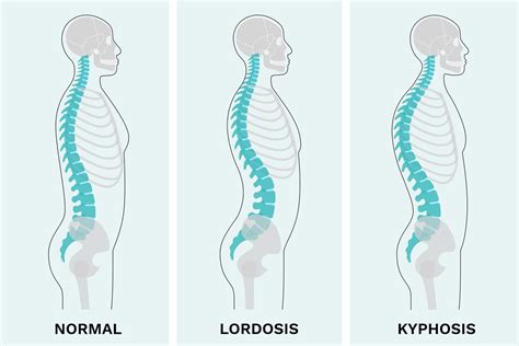 Kyphosis Vs Lordosis Whats The Difference The Healthy