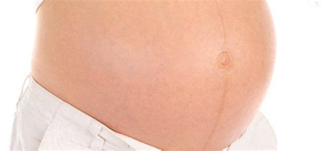 Línea Alba En El Embarazo ¿qué Es Embarazo Alba