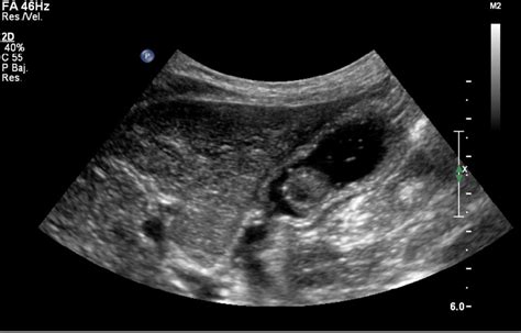 Abdominal Ultrasound Where Polypoid Tumor Is Observed In The Gastric Download Scientific