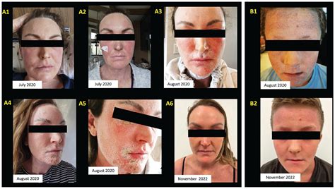 Topical Steroid Withdrawal Syndrome In A Mother And Son A Case Report