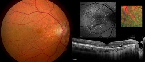 Retinal Degeneration And Persistent Serous Detachment In The Absence Of