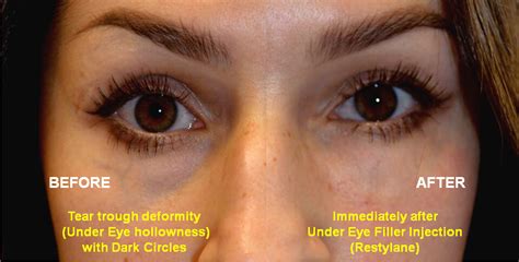 Under Eye Filler Before And After Pictures All You Need Infos
