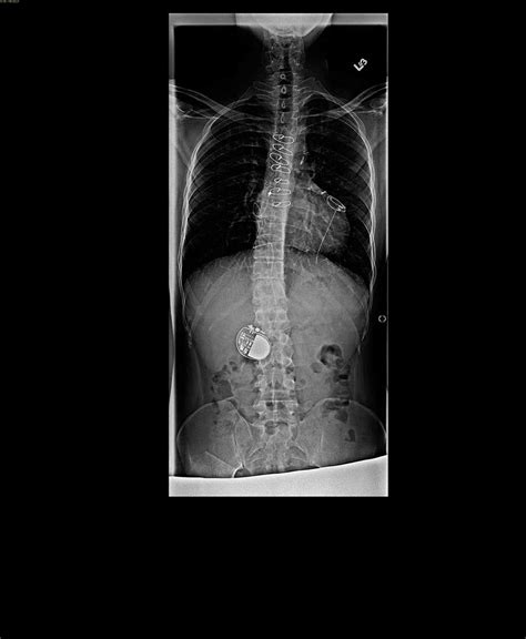 Scheuermanns Disease X Rays Case Studies Ctisus Ct Scanning