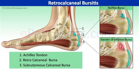 Retrocalcaneal Bursitis Or Achilles Tendon Bursitis Physical Therapy