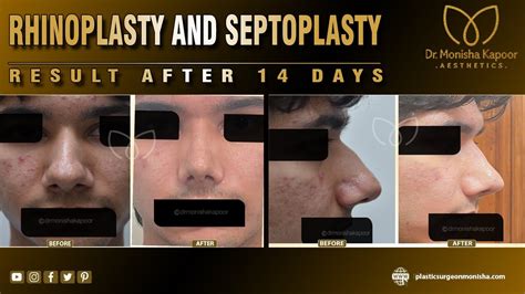 Rhinoplasty Septoplasty In India By Dr Monisha Kapoor Youtube