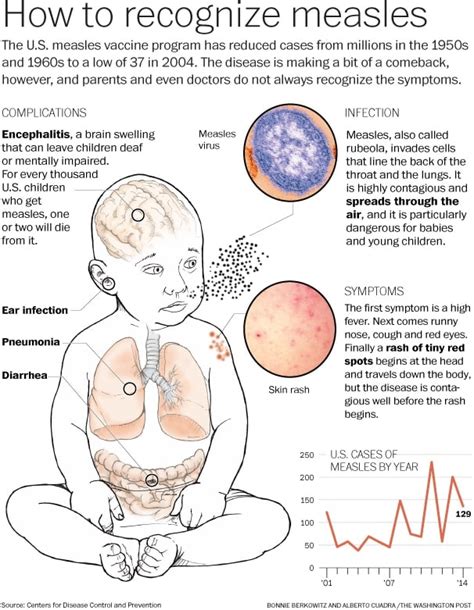 u s measles outbreak sets record for post elimination era the washington post