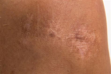 Premium Photo Close Up Scar On Skin Healed Scar