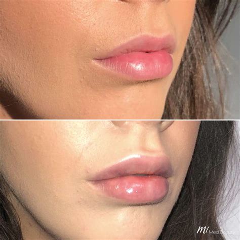 Lip Fillers Starting From 299 M1 Med Beauty Australia