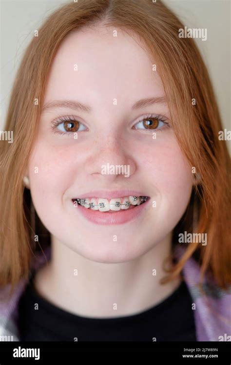 Beautiful Caucasian Young Girl In Dental Braces Smiles Teenage Concept