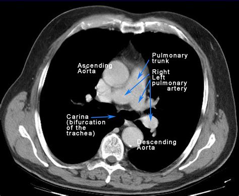 The Anatomy Of Clinical Procedures Lung Cancer