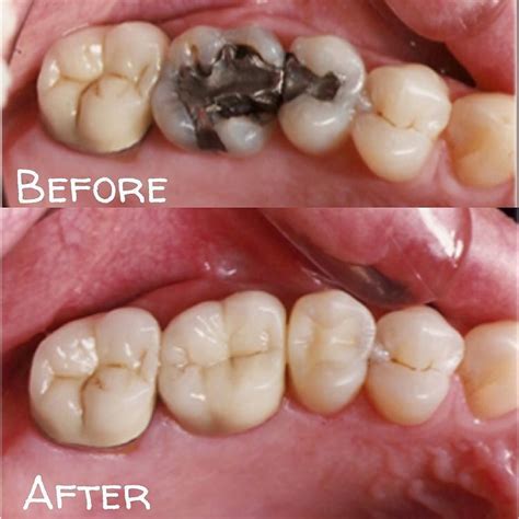 The Beforeandafter Of Replacing Silver Fillings Amalgam With White