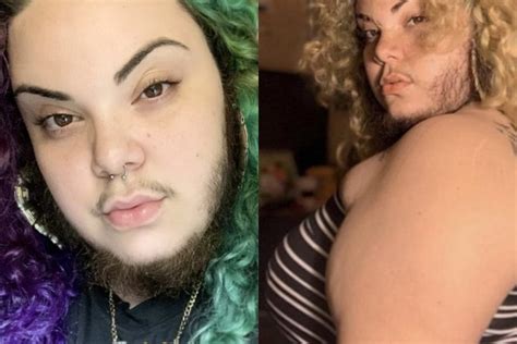 Woman With Excess Facial Hair Caused By Pcos Says Growing Out A Full