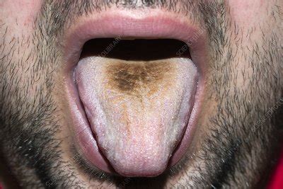 Black Hairy Tongue From Antibiotic Drug Stock Image C