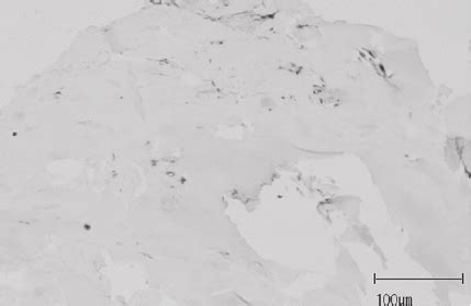 Nodule Of Mature Hyaline Cartilage Left Beneath The Bladder