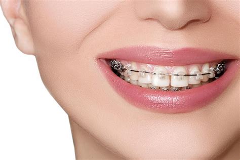 Cosmetic Brace Treatment Starlight Dental Clinic
