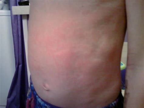 Evidence of true drug sensitization. Amoxicillin Rash Pictures, Causes and Treatment