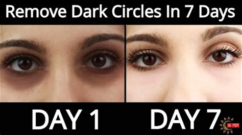 How To Remove Dark Circles Naturally In 3 Days 100results Youtube