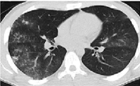 Chest Ct Scan Showing Diffuse Patchy Ground Glass Opacities Mainly On