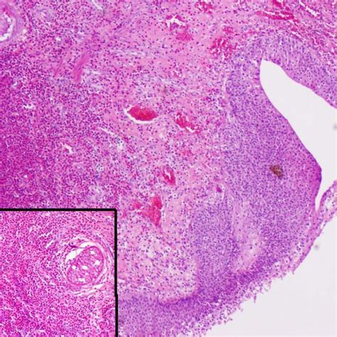 Pdf Eosinophilic Cystitis In Males A Six Year Retrospective Study