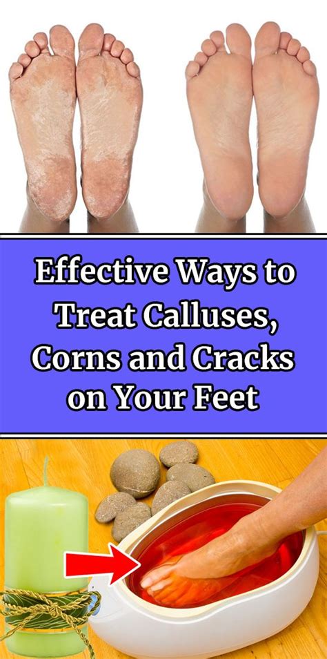 Effective Ways To Treat Calluses Corns And Cracks On Your Feet Health