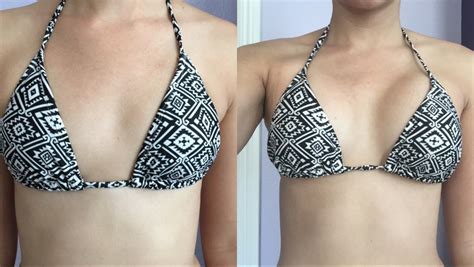 What Are The Top Benefits Of Breast Augmentation?