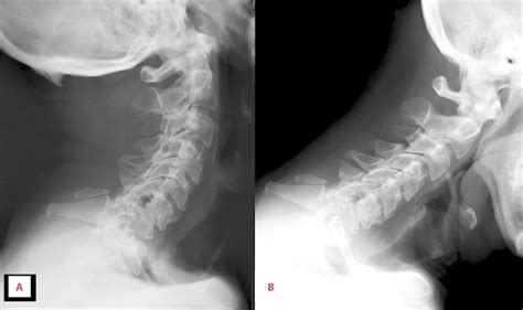 Lateral Cervical Spine X Rays With A Extension View B Flexion View SexiezPicz Web Porn
