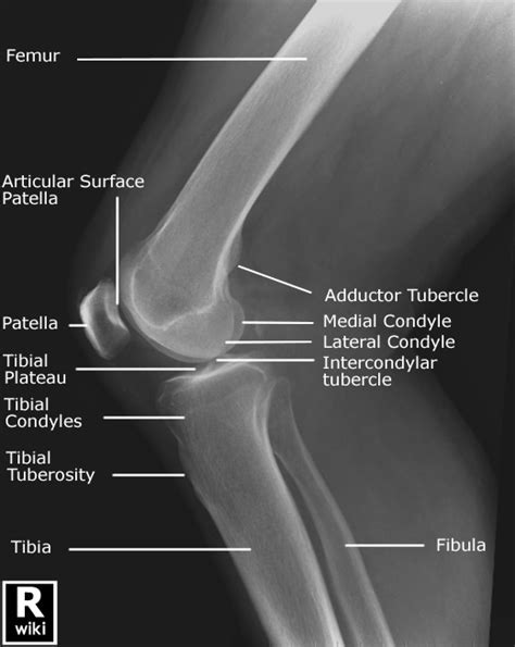 Lateral Knee Radiography - wikiRadiography