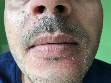 Dermatite Seborreica O Que é Sintomas E Tratamentos Dicas De Saúde