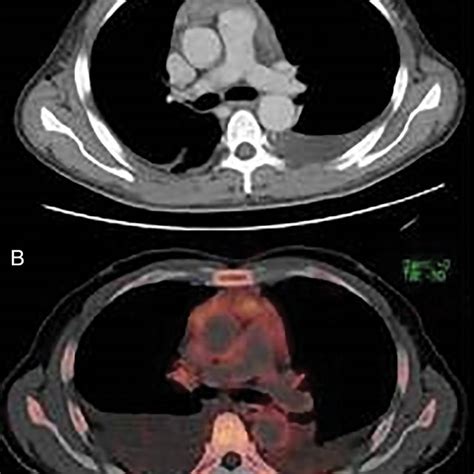 A A Computed Tomography Scan On Admission Showing Anterior Mediastinal