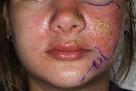 Teenager With Facial Blisters Rash Erythema At Poolside