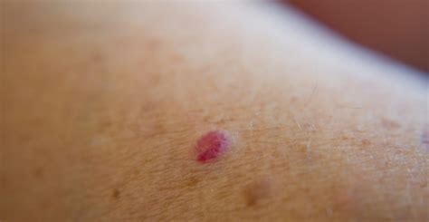 Common Benign Cherry Angiomas Facty Health