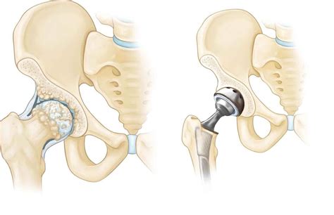 how long does hip replacement last