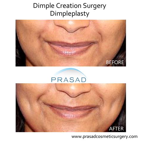 Dimple Surgery Dimple Creation Learn More New York