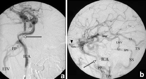 This system which is frequently at variance with. DSA. a Anteroposterior projection, selective injection of ...